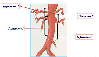 Figure 4. Anatomic Classification of Aortic Aneurysms