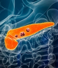 Pancreatic Cancer Image